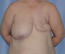 Breast Reconstruction Before and After Pictures in Middletown and Red Bank, NJ