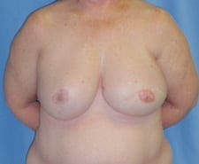 Breast Reconstruction Before and After Pictures in Middletown and Red Bank, NJ