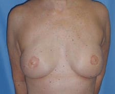 Breast Reconstruction Before and After Pictures in Middletown and Red Bank, NJ