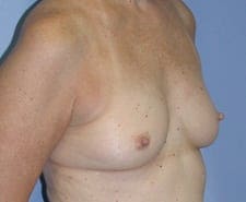 Breast Reconstruction Before and After Pictures in Middletown and Red Bank, NJ