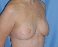 Breast Reconstruction Before and After Pictures in Middletown and Red Bank, NJ