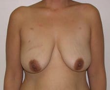 Breast Reconstruction Before and After Pictures in Middletown and Red Bank, NJ