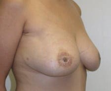 Breast Reconstruction Before and After Pictures in Middletown and Red Bank, NJ