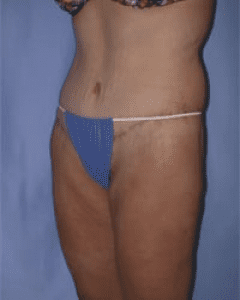 Body Lift Before and After Pictures in Middletown and Red Bank, NJ