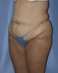 Body Lift Before and After Pictures in Middletown and Red Bank, NJ