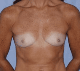 Breast Augmentation Before and After Pictures in Middletown and Red Bank, NJ