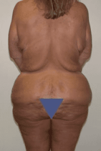 Body Lift Before and After Pictures in Middletown and Red Bank, NJ