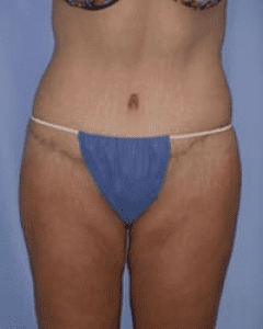 Body Lift Before and After Pictures in Middletown and Red Bank, NJ