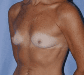 Breast Augmentation Before and After Pictures in Middletown and Red Bank, NJ