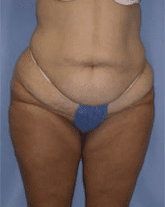 Body Lift Before and After Pictures in Middletown and Red Bank, NJ