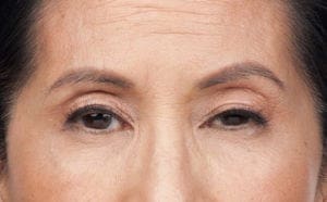 Botox in Middletown, NJ