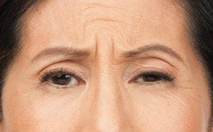 Botox in Middletown, NJ