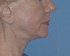 Ultherapy Before and After Pictures in Middletown and Red Bank, NJ
