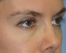 Ultherapy Before and After Pictures in Middletown and Red Bank, NJ